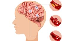 Dampak Keterlambatan Penanganan Pasien Stroke di Indonesia