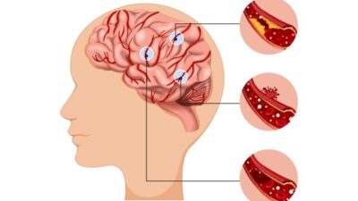 Dampak Keterlambatan Penanganan Pasien Stroke di Indonesia Dampak Keterlambatan Penanganan Pasien Stroke di Indonesia